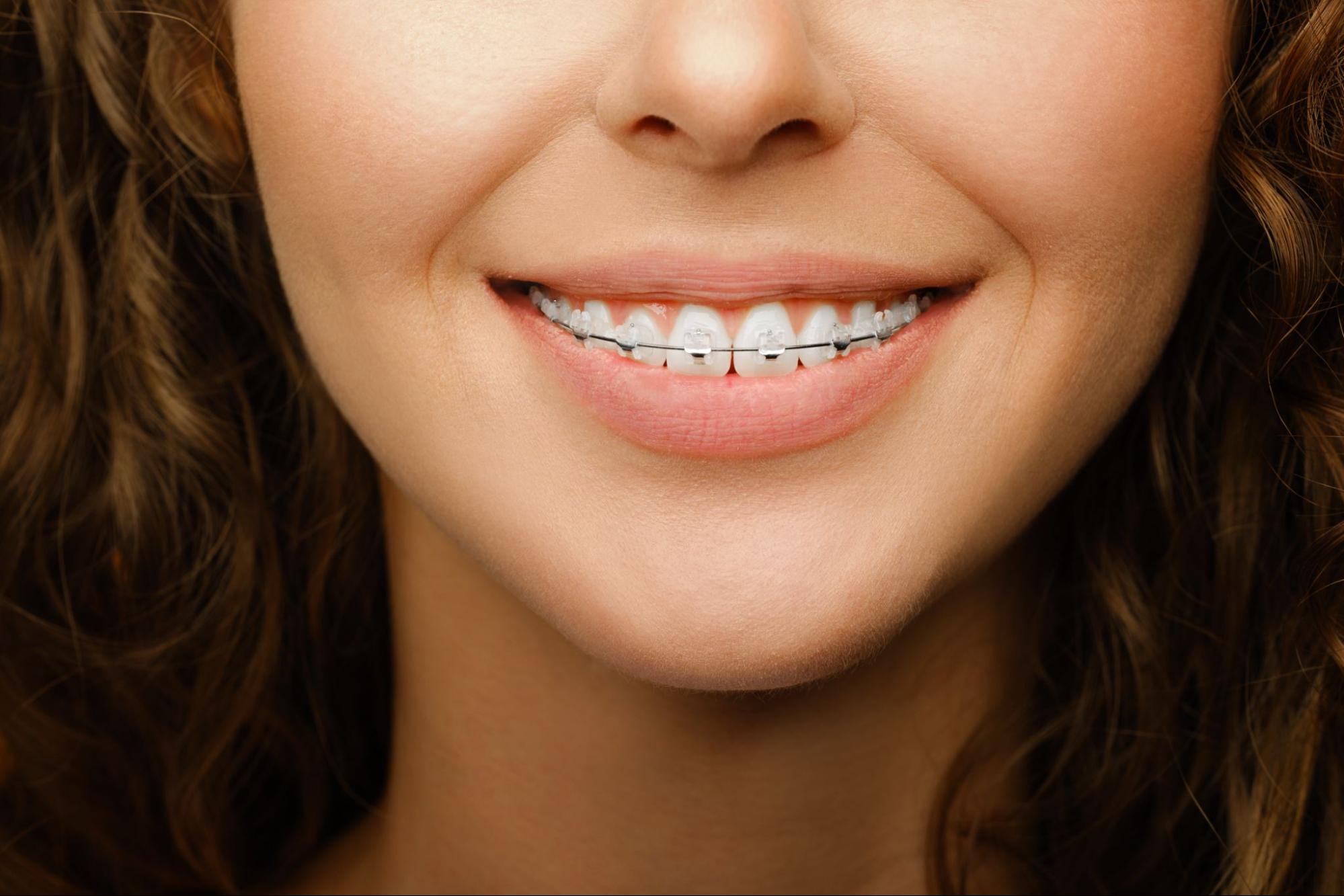 A Beginner’s Guide to Clear Braces